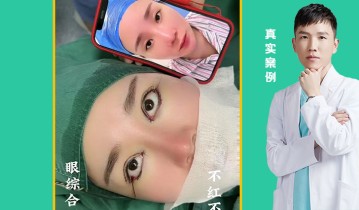 眼综合四项